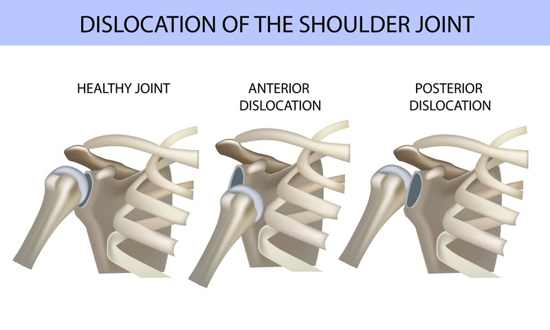 tipi di lussazione alla spalla