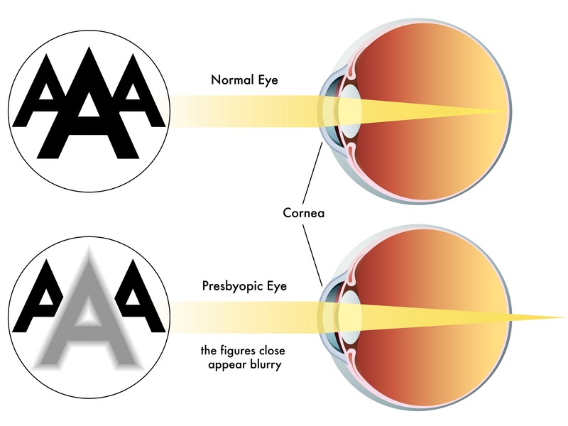 occhio normale e occhio con presbiopia